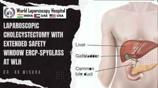 Cholecystectomy with Enhanced Safety Window: Integrating ERCP and SpyGlass Technology