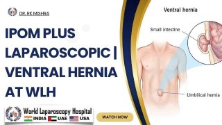 Reinforced Recovery: Laparoscopic IPOM Plus Technique for Ventral Hernia Reconstruction