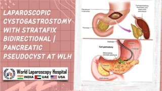Laparoscopic Cystogastrostomy Using Stratafix Bidirectional Sutures for Pancreatic Pseudocyst