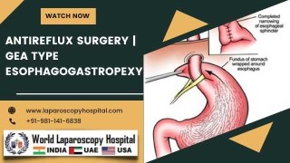 Restoring Esophageal Integrity: GEA-Type Esophagogastropexy in Modern Antireflux Surgery