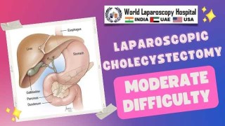 Intermediate-Level Laparoscopic Cholecystectomy: Managing Moderate Complexity