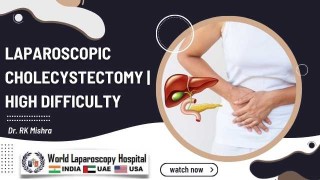 Complex Laparoscopic Cholecystectomy: Mastering High-Difficulty Scenarios