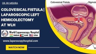 Advances in Laparoscopic Resection of Adrenal Gland Myelolipoma: A Minimally Invasive Approach