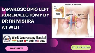 Precision Surgery Redefined: Step-by-Step Laparoscopic Left Adrenalectomy