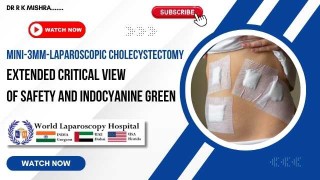 3-mm Micro-Laparoscopic Cholecystectomy:CVS Technique with ICG Fluorescence Guidance