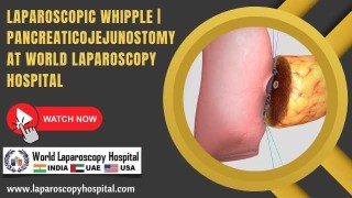 Laparoscopic Pancreaticojejunostomy: Precision Reconstruction in Whipple Surgery