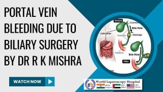 Managing Catastrophic Portal Vein Hemorrhage: A Surgical Challenge in Biliary Procedures