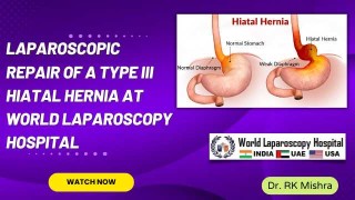 Minimally Invasive Mastery: Laparoscopic Repair of Type III Hiatal Hernia