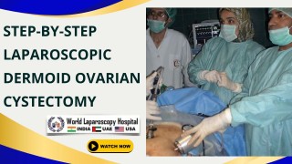 Laparoscopic Management of Dermoid Ovarian Cysts: A Comprehensive Stepwise Approach