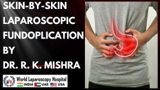 Advanced Skin-by-Skin Laparoscopic Fundoplication: Best Surgery Technique