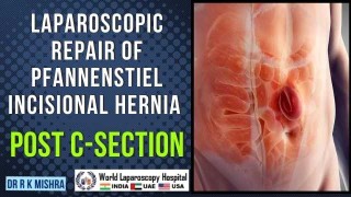 Step-by-Step Laparoscopic Repair of Pfannenstiel Incisional Hernia After Cesarean Section