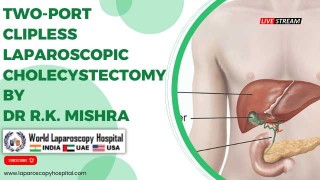 Two-Port Clipless Laparoscopic Cholecystectomy - Minimal Access Surgery at WLH