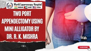 Two Port Appendectomy Skin-to-Skin Technique with Mini Alligator | Dr. R K Mishra
