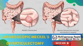 Skin-to-Skin Laparoscopic Meckel's Diverticulectomy | Advanced Minimally Invasive Surgery