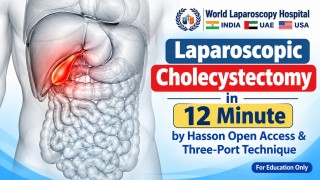 12-Minute Laparoscopic Cholecystectomy Using Hasson Access, Three Ports & ICG