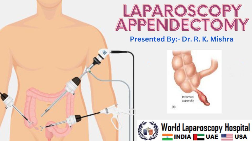 How to perform Laparoscopic Appendectomy step by step? What are the ...