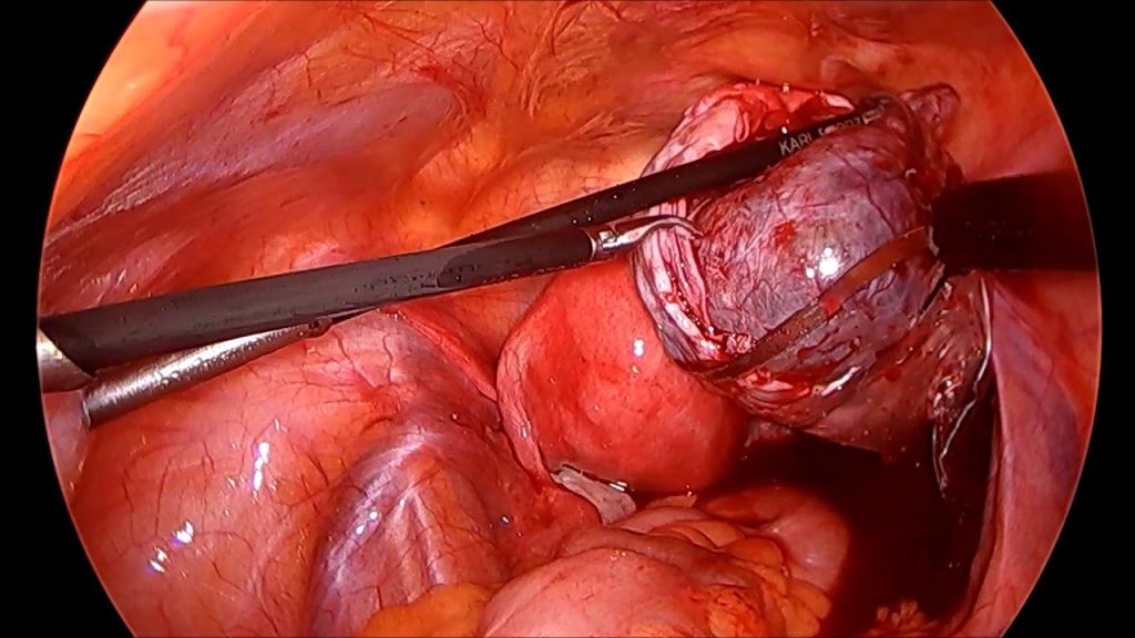 Dermoid Cyst of Ovary - Laparoscopic Removal Without Spillage