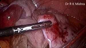 Torted Ovarian Dermoid Cyst in Pregnant Patient