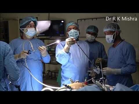 Bariatric Surgery Laparoscopic sleeve Gastrectomy Step by Step Video by Dr R K Mishra