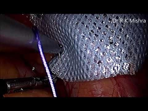 IPOM Inguinal Hernia by Dr. R. K. Mishra