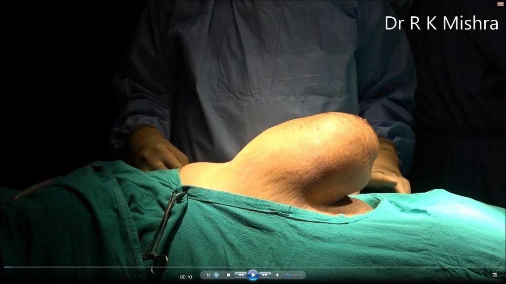 Laparoscopic Repair of Huge Incisional Hernia