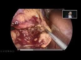 Laparoscopic Nephrectomy