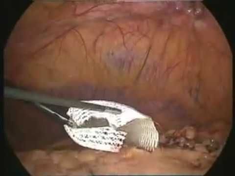 IPOM Umbilical Hernia Repair by VIPRO II Mesh