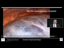 Laparoscopic Surgery for Ovarian Cyst Diseases