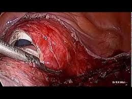 Tips and Tricks for Hysterectomy