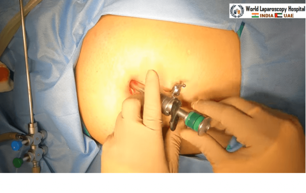 Laparoscopic Ablation and Fulguration of Endometriosis of Cul-De-Sac