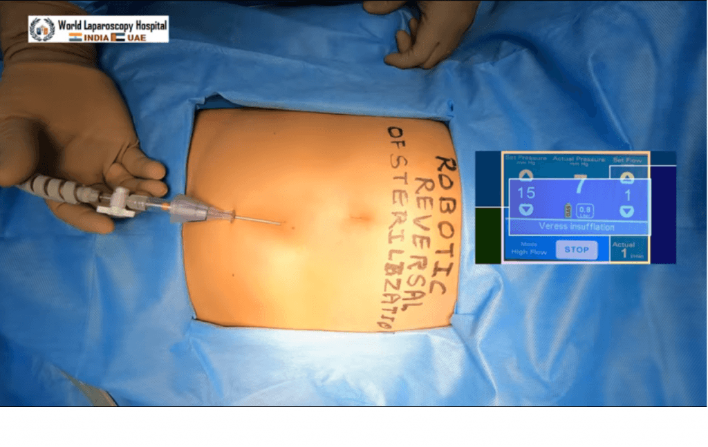 Robotic Reversal of Tubal Sterilization