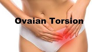 Laparoscopic Oophorectomy for Ovarian Torsion