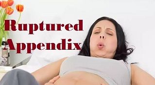 Laparoscopic Management of Retrocecal Ruptured Appendix