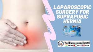 Laparoscopic Management of Suprapubic Incisional Hernia