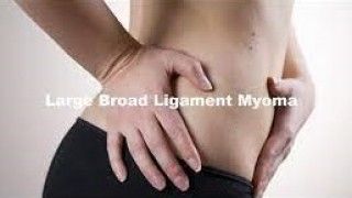 Laparoscopic Myomectomy for Large Broad ligament Fibroid
