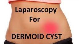 Laparoscopic Surgery For Ovarian Dermoid Cyst