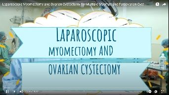 Laparoscopic Myomectomy and Ovarian Cystectomy for Multiple Myomas and Paraovarian Cyst