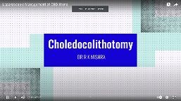 Laparoscopic Management of CBD Stone