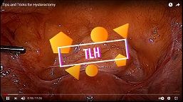 Laparoscopic Myomectomy for Broad Ligament Myoma