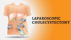 Laparoscopic Cholecystectomy with Laparoscopic Ovarian Drilling