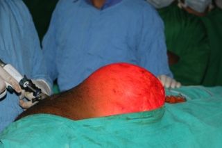 IPOM Inguinal Hernia by Dr. R. K. Mishra