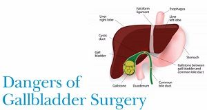Dangerous way of Performing Laparoscopic Cholecystectomy