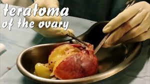 Laparoscopic Management of Ovarian Teratoma