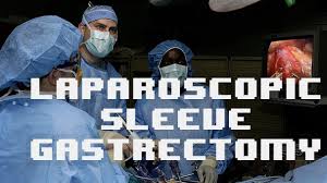 Laparoscopic Sleeve Gastrectomy Surgery Video Explained Step by Step