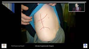 Retroperitoneoscopic Nephrectomy and Ureterolithotomy