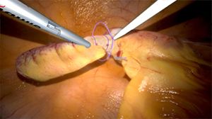 Laparoscopic Appendectomy - Immediate Laparoscopy is Ideal for Acute Appendicitis