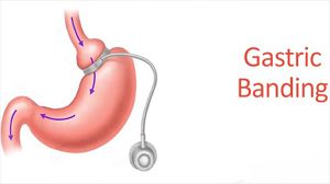 Gastric Banding