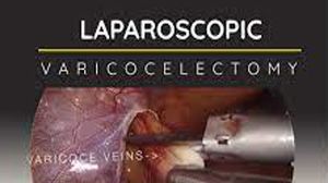 Laparoscopic Varicocelectomy