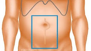 लेप्रोस्कोपिक कोलेसिस्टेक्टोमी नया 'गोल्ड स्टैंडर्ड' का वीडियो देखें।