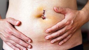 Umbilical and Paraumbilical Hernia Surgery